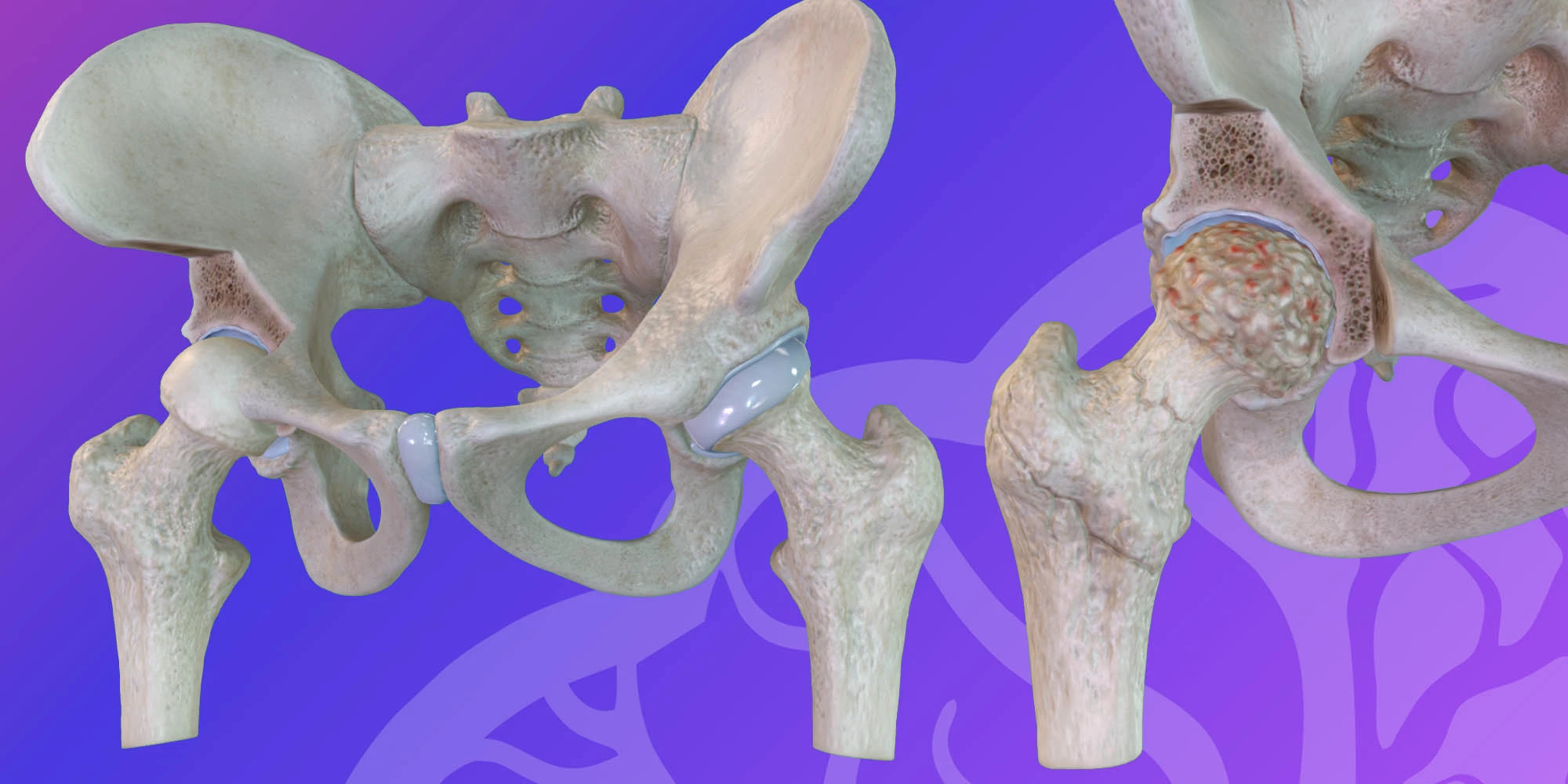 Pelvis hip joint osteoarthritis image